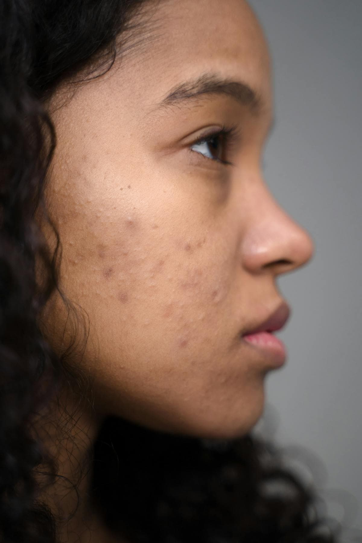 Acne treatment