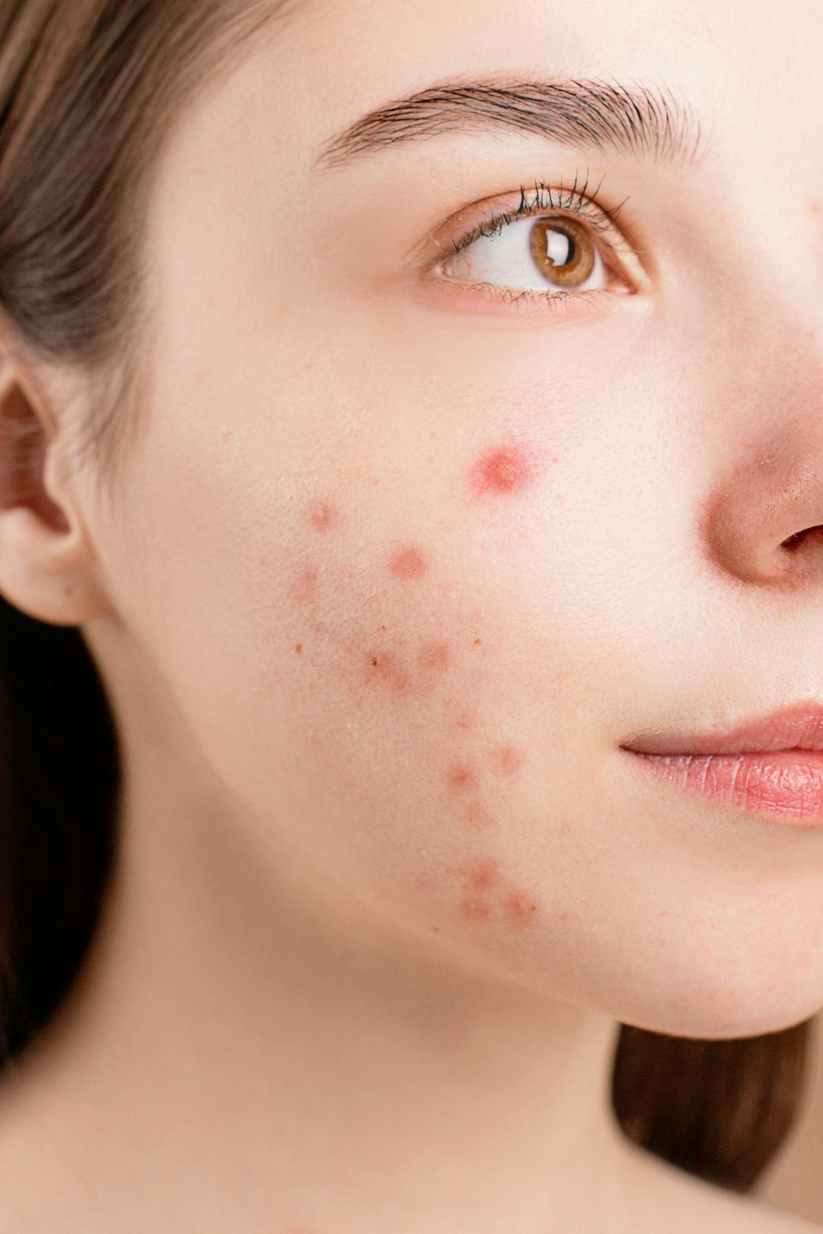 Acne Scars treatment